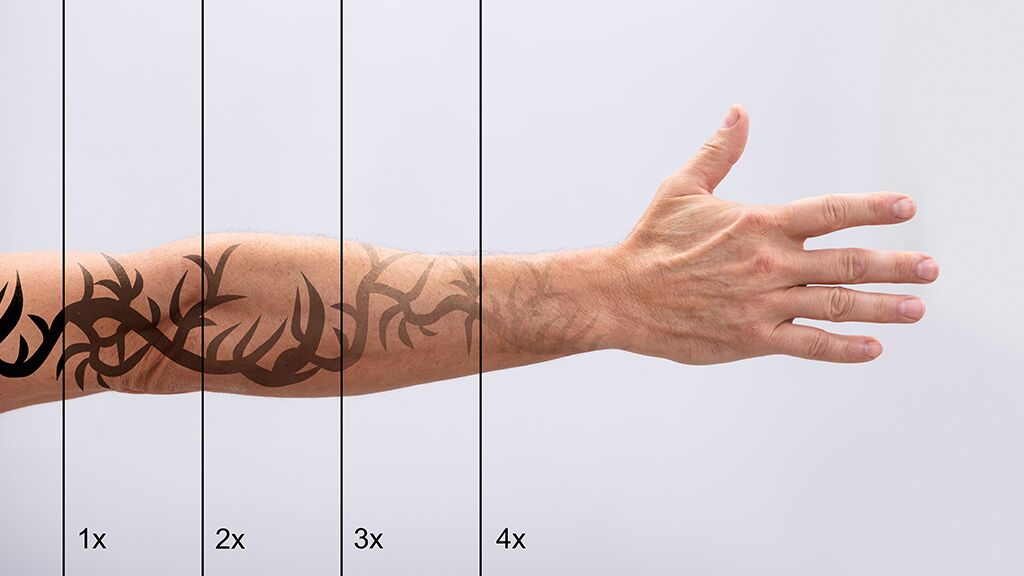 Mann bereut Tattoo, dann macht er diese verrückte Sache